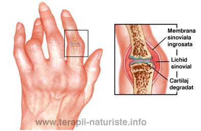 Tratament naturist pentru Artrita reumatoida pe terapii-naturiste.info
