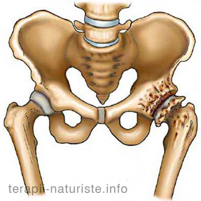 artroză roșeață a articulațiilor artroza distrofică a articulației șoldului