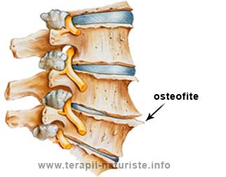 Tratament naturist pentru Osteofite