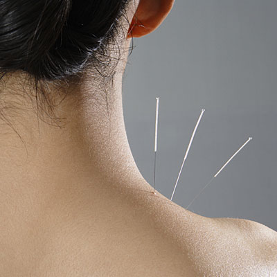 Tratament naturist prin Acupunctura