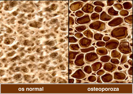 Tratament naturist pentru Osteoporoza